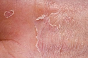 eczema closeup