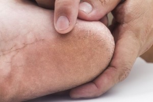 Psoriasis and Eczema dry hands & feet