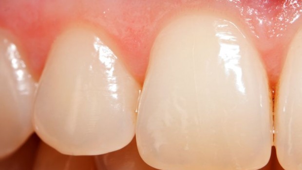 10 Ways to Treat Celiac Disease Related Tooth Enamel Decay
